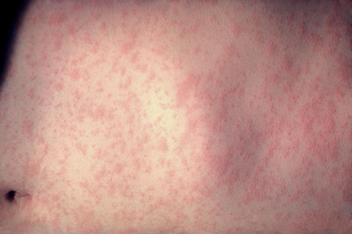 Close-up of a measles rash three days after symptoms began.